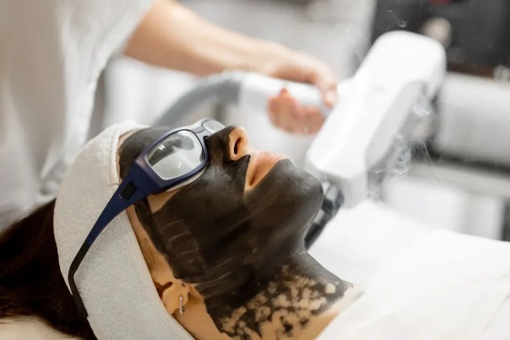 Carbon laser facial treatment