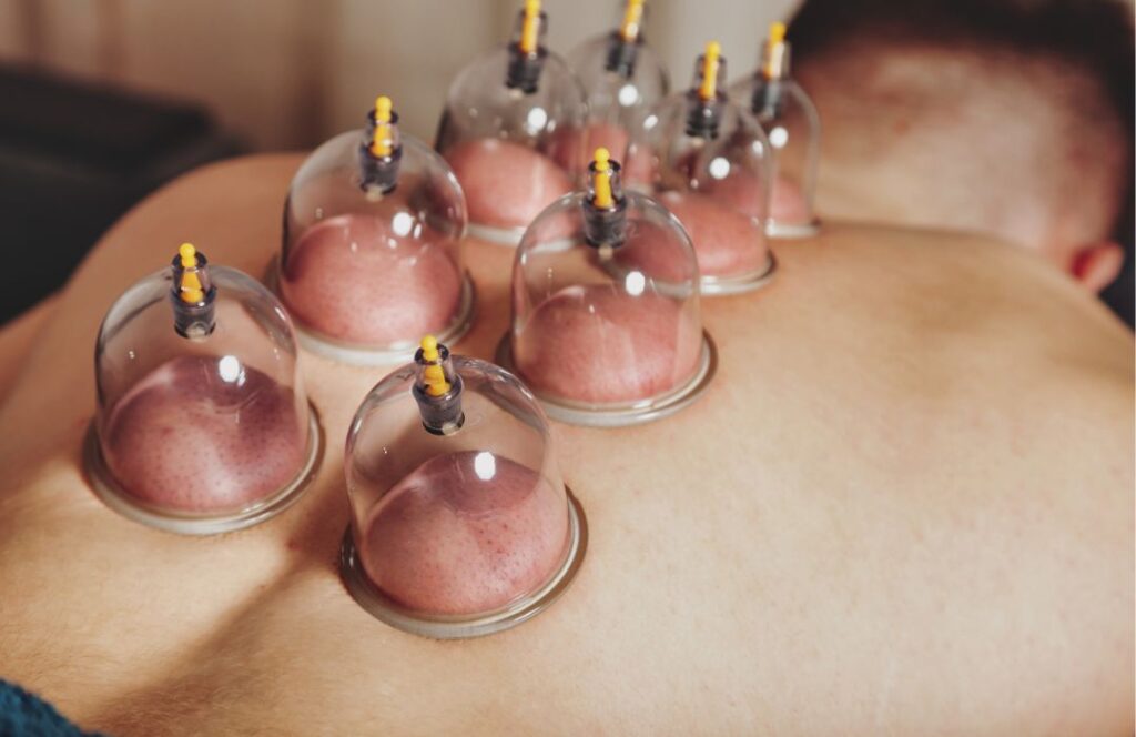 Cupping therapy
